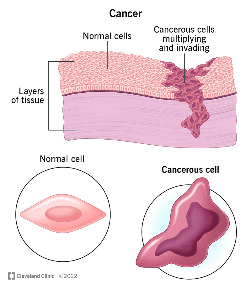 Cancer Care
